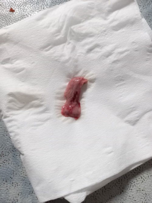 Kemungkinan keguguran setelah keluar flek berminggu-minggu