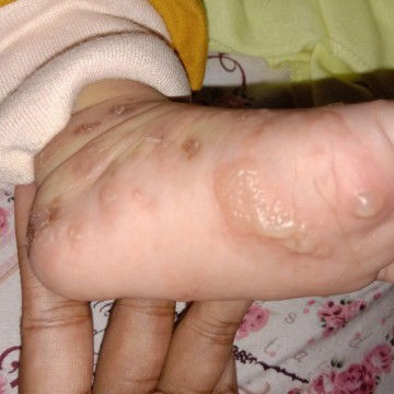 Ini scabies atau apa ya?
