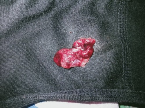 Saya hamil 8minggu mengeluarkan darah seperti menstruasi dan mengeluarkan gumpalan darah.