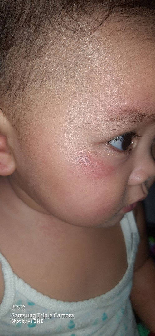 Hi po, breastfeeding mom here.. ask qoh lng po ano tong mga rashes nah ganito kay baby?
