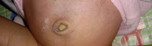 Tali pusat sudah puput