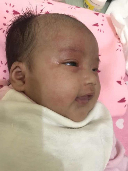 Bercak kemerahan di wajah bayi