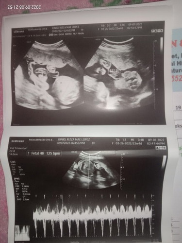 May makakapag explain Po ba ng result ng ultrasound ko?d kc inexplain sakin,bat kya gnun ung result
