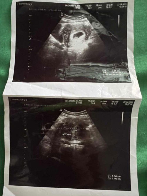 ตรวจพบเนื้องอกขณะตั้งครรภ์เครียดมากท้องแรกด้วยค่ะ อายุ38ค่ะ ใครเจอเหตุการณ์แบบนี้บางค่ะ รูปบนคือน้องค่ะรูปล่างคือก้อนเนื้องอก