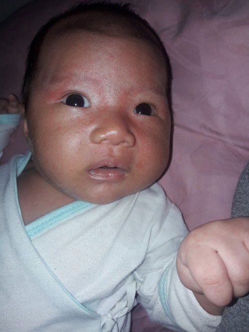 Face rashes ni baby