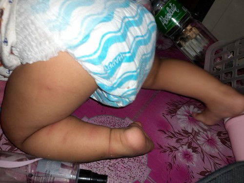 Safe poba ang BL cream para ss insect bites para di mangitim