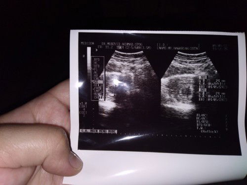 Masuk 7 week tapi masih kantong janin