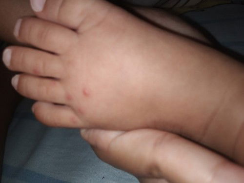 ตุ่มแดงๆแข็งๆ