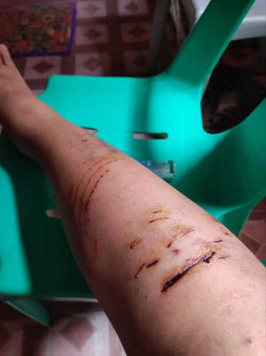 MAY SIDE EFFECT PO BA SA BUNTIS ANG ANTI-RABBIES?