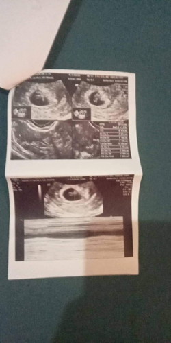 Normal po ba na my brown na discharge 5months preggy?