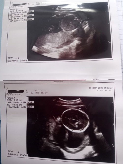 ท้องแรกค่ะ หมอไม่ได้บอกเพศ หมอซาวด์ภาพให้ดู ภาพบนหลังน้องค่ะ ส่วนภาพล่างคือด้านข้างค่ะ