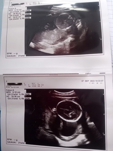 ท้องแรกค่ะ หมอไม่ได้บอกเพศ หมอซาวด์ภาพให้ดู ภาพบนหลังน้องค่ะ ส่วนภาพล่างคือด้านข้างค่ะ