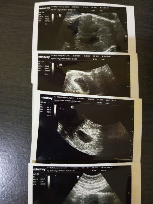 Berbagi cerita , kehamilan 7 minggu awal usg transvaginal Dan 4d, dipertahankan sampai 13w