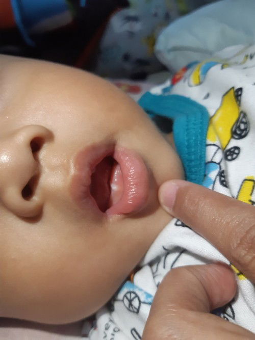 Gigi susu tumbuhnya miring apakah normal?