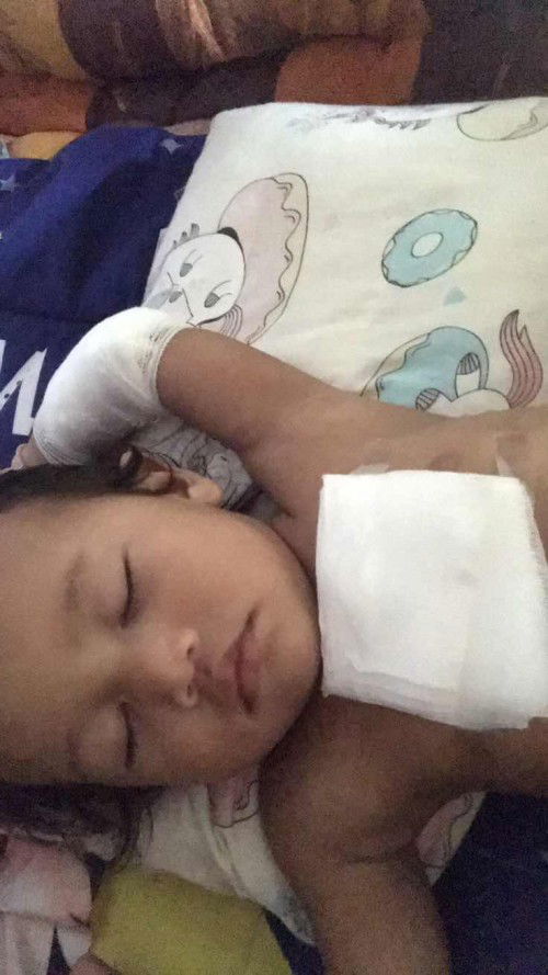 ยาทาแผลสำหรับแผลโดนความร้อนลวก