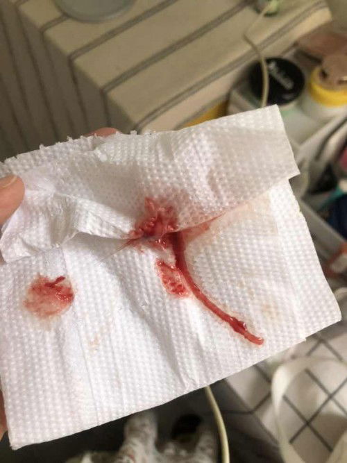 ไม่ปวดท้อง แต่ปากมดลูกเปิดแล้วเกือบ 2 เซ็นต์