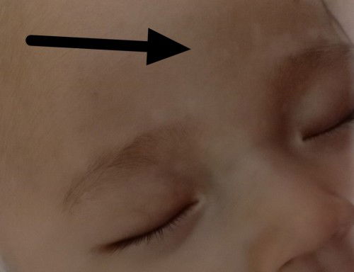 Putih putih di kening bayi