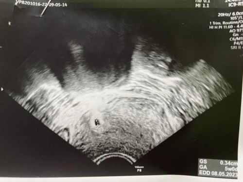 5 วีค ถุงครรภ์ฝังอยู่ริมมดลูกข้างขวา