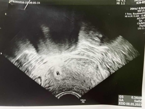 5 วีค ถุงครรภ์ฝังอยู่ริมมดลูกข้างขวา