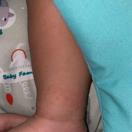 Bintik bintik pada kulit bayi