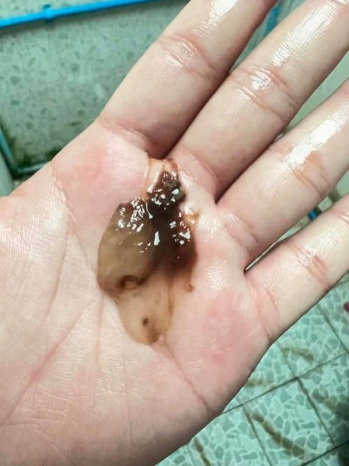 มีมูกปนสีน้ำตาล