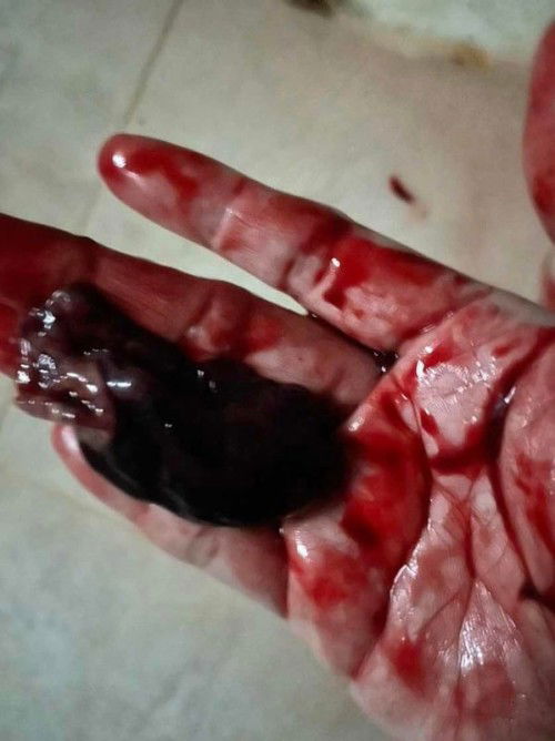 สอบถาม12w3d เป็นท้องลมไม่เห็นตัวเด็กหลุดออกมาเองมีถุงตั้งครรภ์ แท้งใช่มั้ยค่ะ ต้องรีบไปหาหมอด้วยไหมคะ ต้องขูดมดลูกด้วยไหมค่ะ