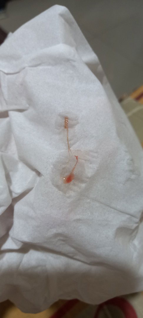 Flek di kehamilan 12 week