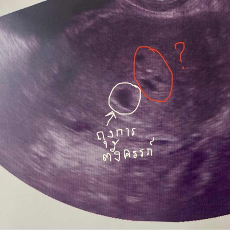 5 week เจอถุงตั้งครรภ์ แต่ข้างๆถุงมีเหมือนถุงน้ำอะไรไม่รู้ 3 ถุง แม่ๆคนไหนเคยเป็นไหมคะ
