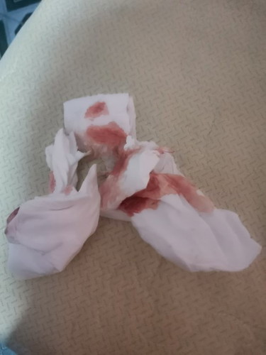 Bloody discharge after walking