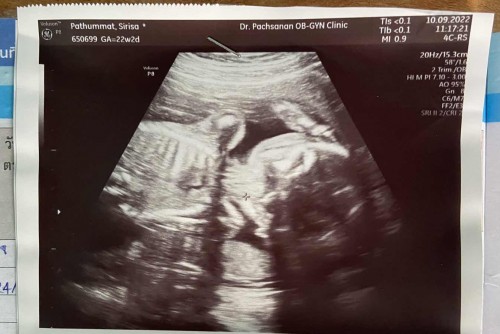 คุณแม่ดูออกมั้ยคะว่าน้องนอนอยู่ในท่าแบบไหน คุณหมอไม่ได้บอก และ เด็ก22w2d หนัก420gถือว่าตัวเล็กมั้ย