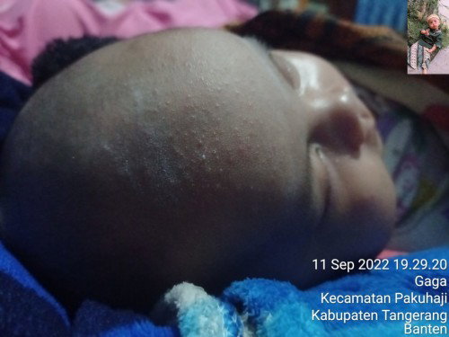 Biang keringet pada bayi