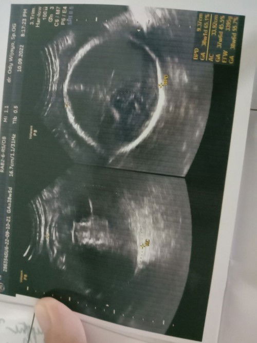 Hasil usg akurat ga?