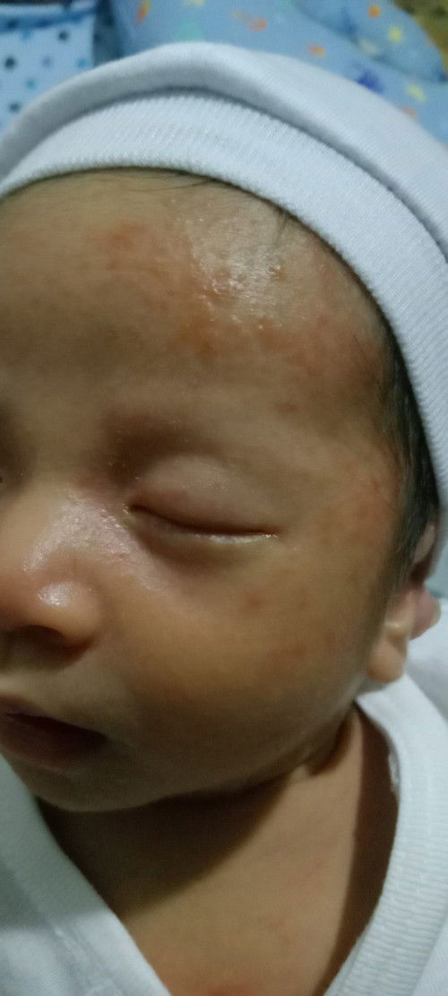 Baby acne po ba itong nasa mukha ni baby o rashes?