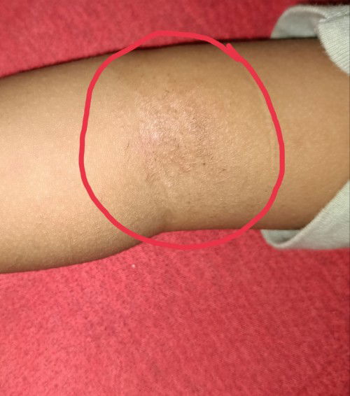 Gatal pada lipatan siku anak