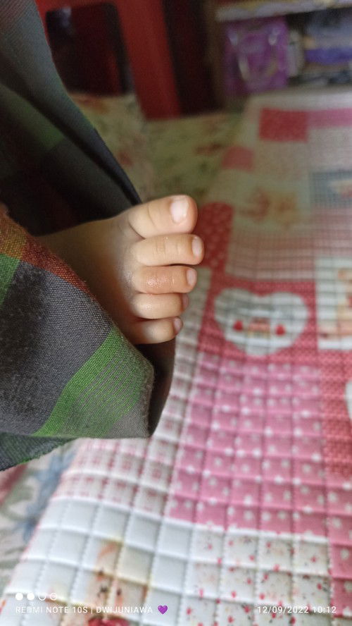 Jari kaki seperti lada benjolan lebam