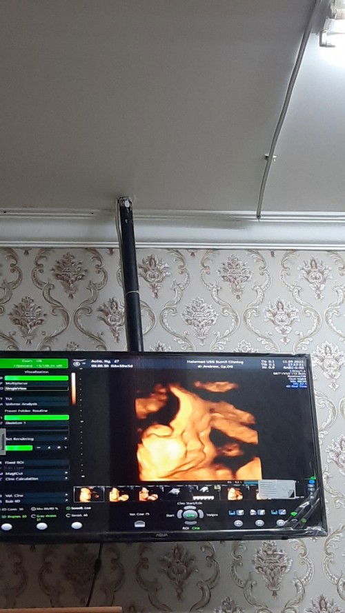 USG bayi 35week hpl oktober