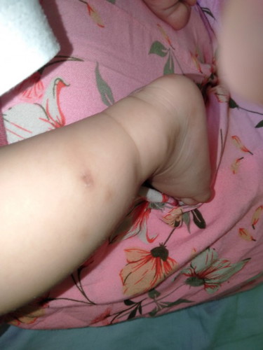 mosquito bite scar?