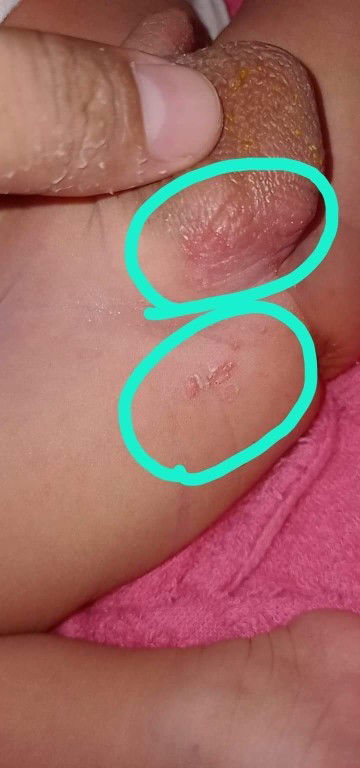 ไม่ทราบว่าขาหนีบลูกเป็นอะไร เป็นผื่นรึป่าวค่ะแม่ๆ ใช้อะไรถึงจะหาย กังวลมีมากืสางสารน้องด้วย