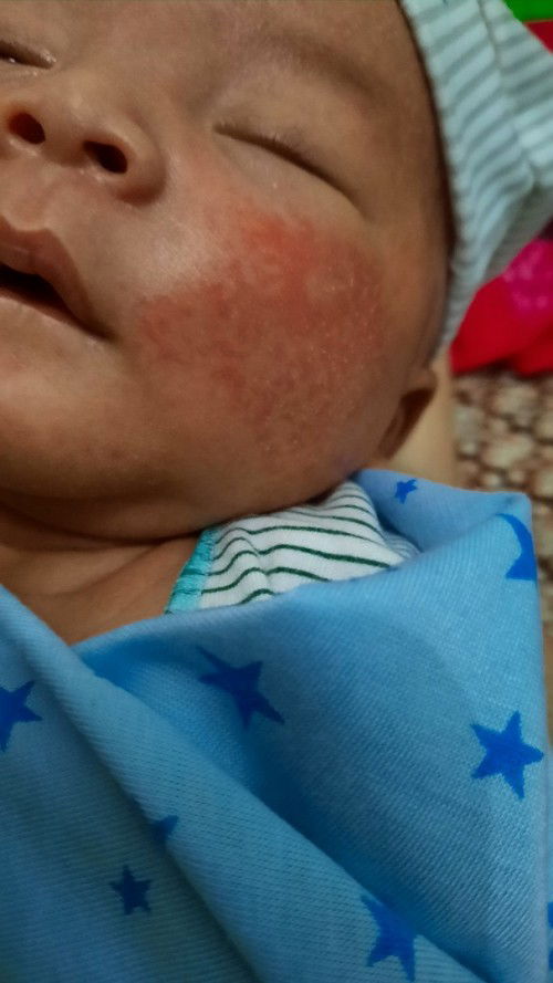 Pipi bayi bintik merah