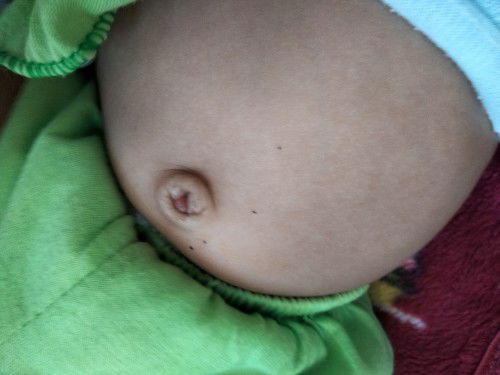 Tali pusar berair umur 3 bulan