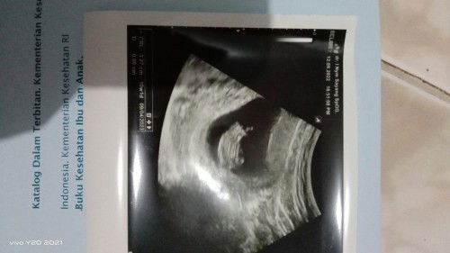 Bun ini td saya usg uda 10w tp sy tanya uda ada djjnya .. dijawab suda tp mash kecil katanya