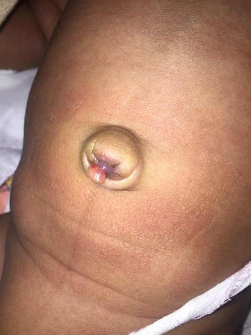 Pusar belum kering dan muncul granuloma