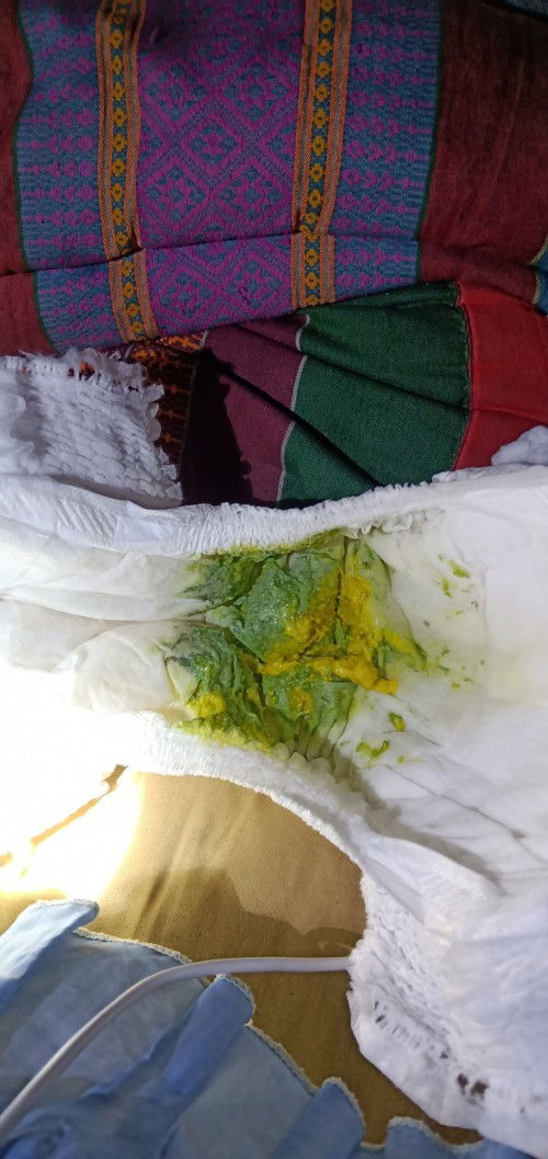 ลูกถ่ายออกมาเปนแบบนี้จะเปนอะไรไหมค่ะลูกยังไม่ถึงเดือนเลยคะกังวนมากคะน้องกินนมชงคะ