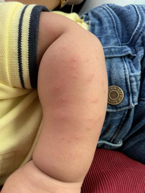 Baby naik ruam timbul