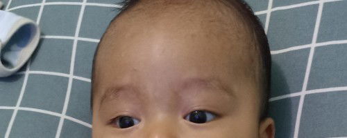 bercak putih di dahi seperti panu