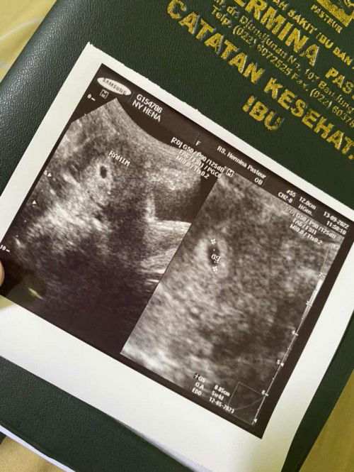 Ada yg sama itungan hpht sm usg berbeda??