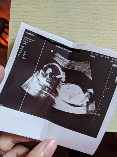 Ultrasound @ 17 wks