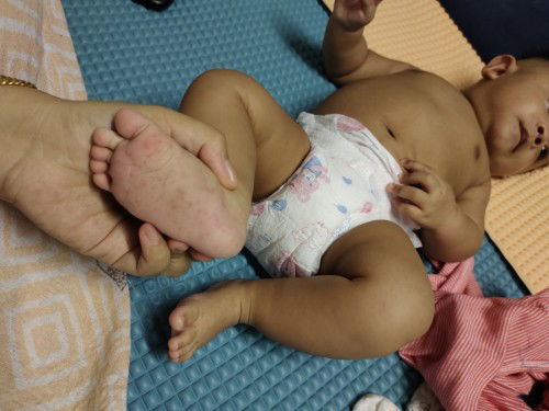 Ruam di tapak kaki, leher dan kawasan bawah perut