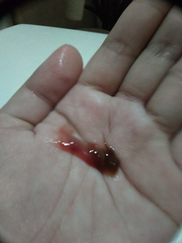 blood discharge/brown discharge