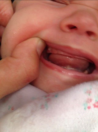 Bintik putih pada gusi bayi 3 bulan